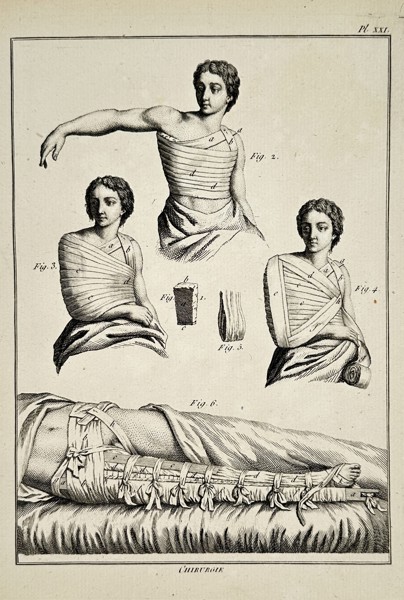 Robert Bénard (1734–1777) – Technical Study of Surgical Bandages for Limbs and Torso – Engraving (18th Century)