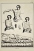 Robert Bénard (1734–1777) – Technical Study of Surgical Bandages for Limbs and Torso – Engraving (18th Century)