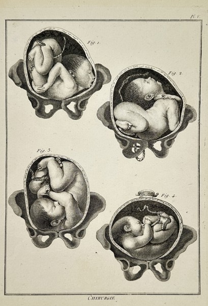 Robert Bénard (1734–1777) – Obstetrical Study of Fetal Positions in the Womb – Engraving (18th Century)