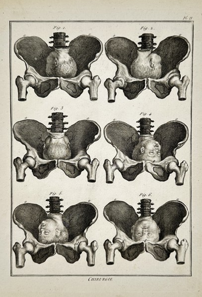 Robert Bénard (1734–1777) – Obstetrical Study of Fetal Presentation in the Pelvis – Engraving (18th Century)