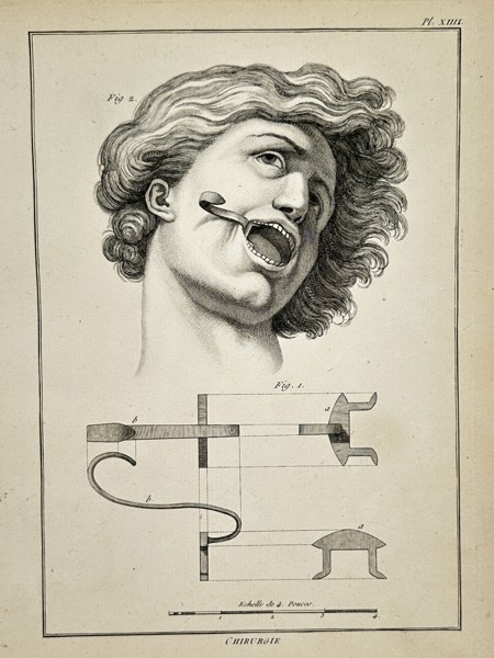 Robert Bénard (1734–1777) – Technical Study of a Mouth Speculum and Surgical Application – Engraving (18th Century)