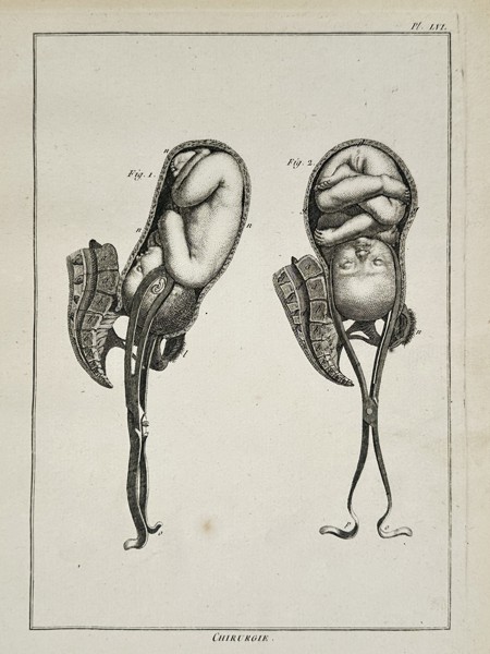 Robert Benard (1734-1785) – Obstetric Surgery and Use of Forceps – Engraving (1771)