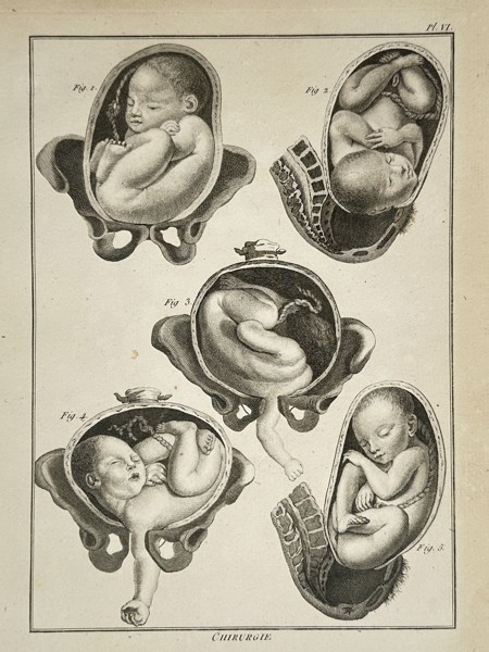 Denis Diderot (1713–1784) – Studies of Fetal Presentation and Childbirth – Engraving (1762–1772)