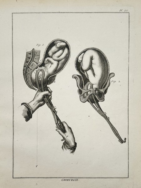 Denis Diderot (1713–1784) – Anatomical Study of Forceps Delivery – Engraving (1762–1772)