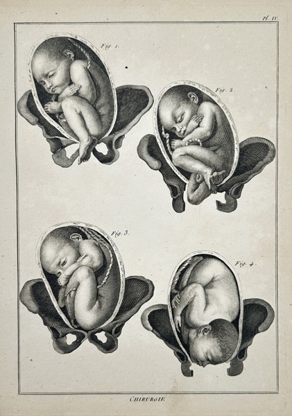 Robert Benard (1734–1777) – Anatomical Study of Fetal Positions in the Pelvis – Engraving (1762)