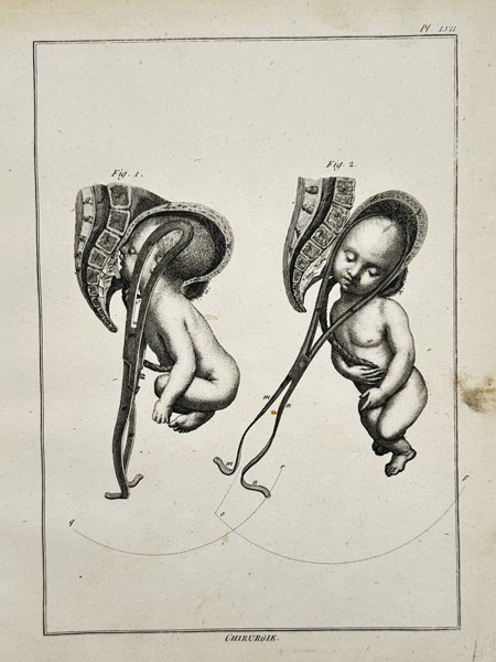 Robert Benard (1734–1777) – Obstetrical Forceps and Fetal Delivery – Engraving (1762)