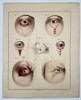 Paul Steglich (Active 19th Century) – Surgical Diagrams of Ophthalmic Procedures – Hand-coloured engraving (1840)