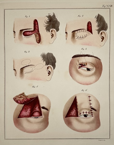 Paul Steglich (Active 19th Century) – Surgical Diagrams of Forehead Flap Rhinoplasty and Eyelid Reconstruction – Hand-coloured engraving (1840)