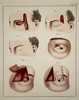Paul Steglich (Active 19th Century) – Surgical Diagrams of Forehead Flap Rhinoplasty and Eyelid Reconstruction – Hand-coloured engraving (1840)