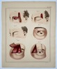 Paul Steglich (Active 19th Century) – Surgical Diagrams of Forehead Flap Rhinoplasty and Eyelid Reconstruction – Hand-coloured engraving (1840)