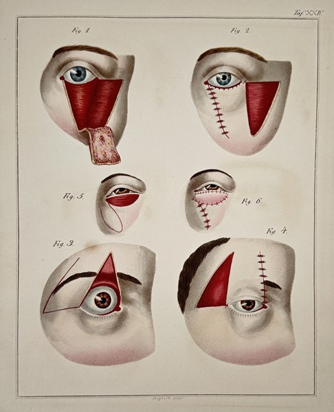 Paul Steglich (Active 19th Century) – Surgical Diagrams of Periorbital Tissue Flap Procedures – Hand-coloured engraving (1840)