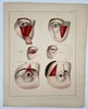 Paul Steglich (Active 19th Century) – Surgical Diagrams of Periorbital Tissue Flap Procedures – Hand-coloured engraving (1840)