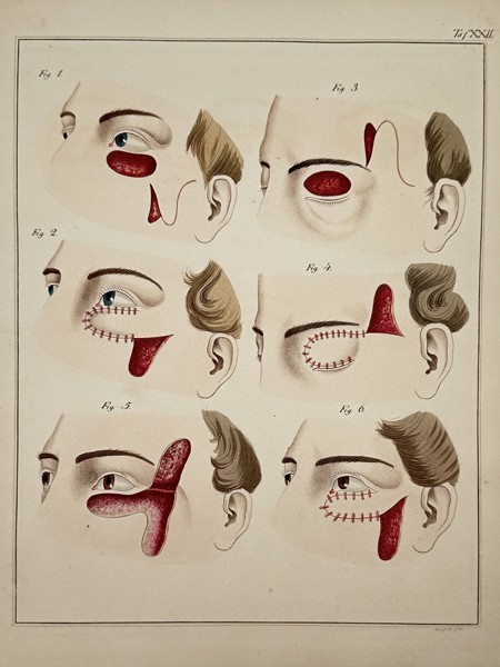 Paul Steglich (Active 19th Century) – Surgical Diagrams of Malar and Periorbital Flap Procedures – Hand-coloured engraving (1840)
