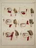 Paul Steglich (Active 19th Century) – Surgical Diagrams of Malar and Periorbital Flap Procedures – Hand-coloured engraving (1840)
