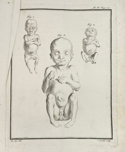 Jacques de Sève – Anatomical Study of Infants with Developmental Anomalies