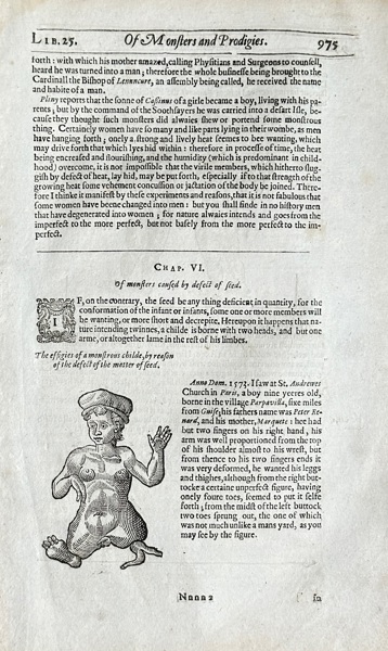 Ambroise Paré (c. 1510–1590) – Illustration of a Child with Physical Deformities – Woodcut (1634)