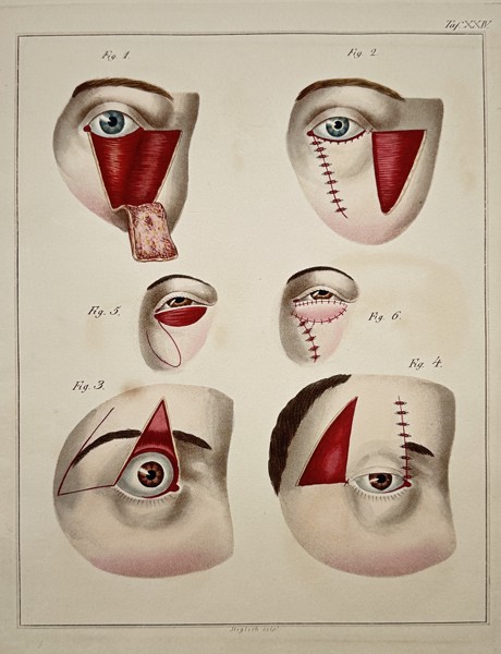 Steglich (19th Century) – Surgical Procedures on the Eye and Eyelid (Figure XXV) – Engraving with hand-coloring (c. 1830)