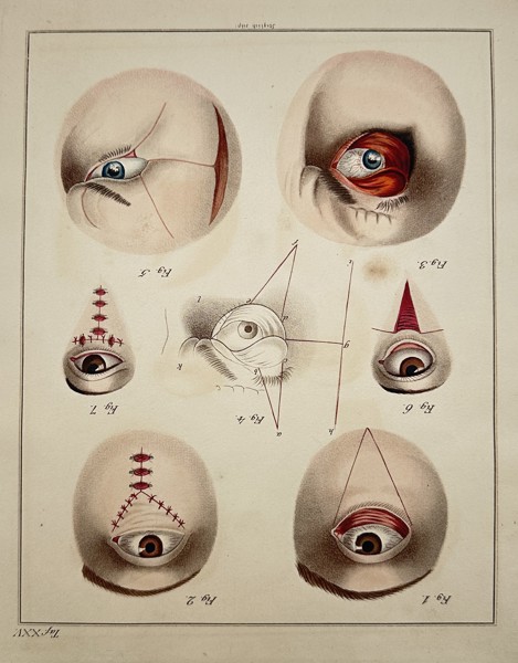 Steglich (19th Century) – Surgical Procedures on the Eye and Eyelid (Taf. XXV) – Engraving with hand-coloring (c. 1830)