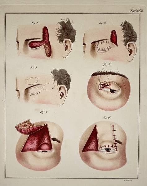 Steglich (19th Century) – Surgical Procedures on the Eyelid and Temple (Fig. XXIII) – Engraving with hand-coloring (c. 1830)