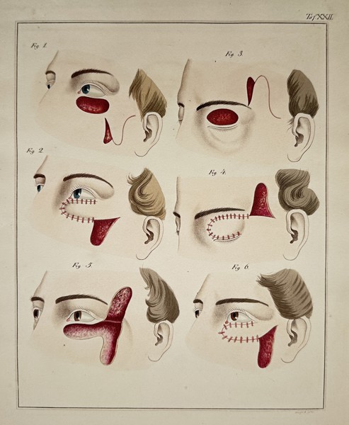 Steglich (19th Century) – Surgical Flaps for Eyelid and Facial Reconstruction (Taf. XXII) – Engraving with hand-coloring (c. 1830)