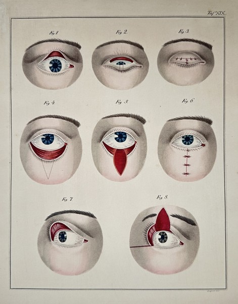 Hermann Eduard Fritze (1811–1866) & Georg Friedrich Otto Reich (b. 1807) – Surgical Procedures on the Eye (Fig. XIX) – Engraving with hand-coloring (c. 1845)