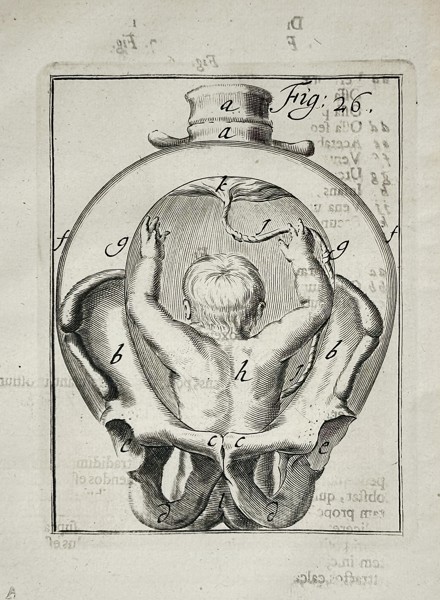Hendrik van Deventer (1651–1724) – Obstetric Illustration of Fetal Presentation within the Pelvis – Copperplate engraving (1701)