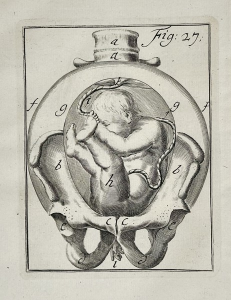 Hendrik van Deventer (1651–1724) – Obstetric Illustration of Fetal Malpresentation in the Womb – Copperplate engraving (1701)