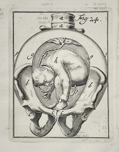 Hendrik van Deventer (1651–1724) – Obstetric Illustration of Fetal Presentation in the Pelvis (Complicated Lie) – Copperplate engraving (1701)