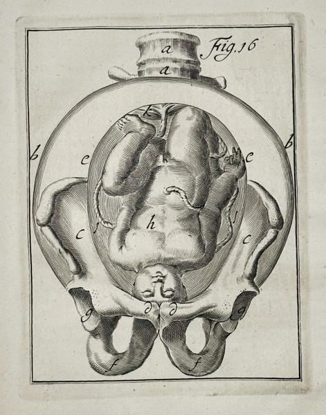 Hendrik van Deventer (1651–1724) – Obstetric Illustration of Fetal Malpresentation in the Pelvic Inlet – Copperplate engraving (1701)