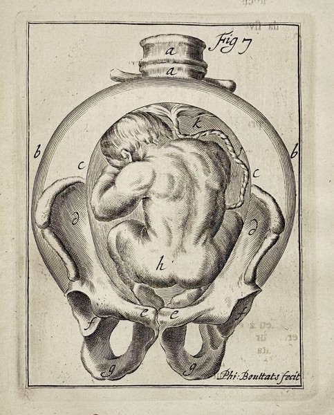 Hendrik van Deventer (1651–1724) – Fetus in Utero within Pelvis, Figure 7 – Engraving (Circa 1701-1733)