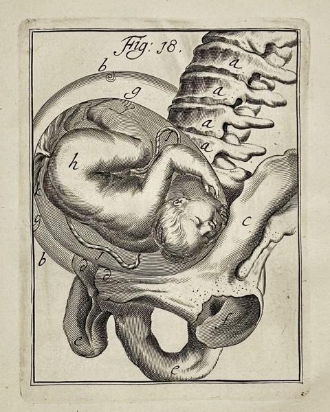 Hendrik van Deventer (1651–1724) – Obstetrical Illustration of Fetal Presentation – Engraving (Circa 1701-1733)