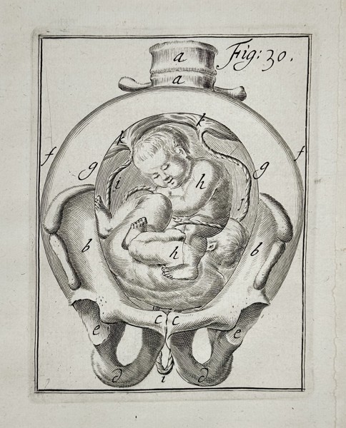 Hendrik van Deventer (1657–1724) - Twin Fetus Presentation in the Pelvis - Copperplate Engraving (Early 18th Century)