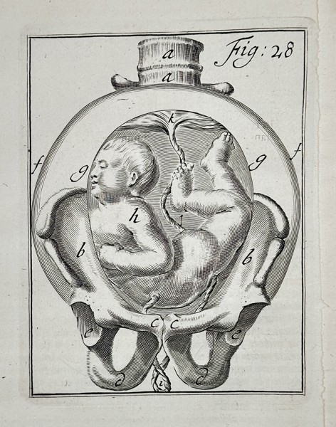 Hendrik van Deventer (1657–1724) - Breech Fetus Presentation - Copperplate Engraving (Early 18th Century)