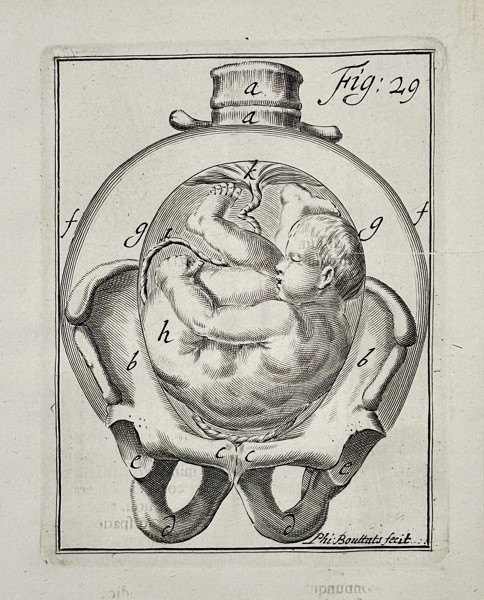 Hendrik van Deventer (1657–1724) - Vertex Fetus Presentation - Copperplate Engraving (Early 18th Century)